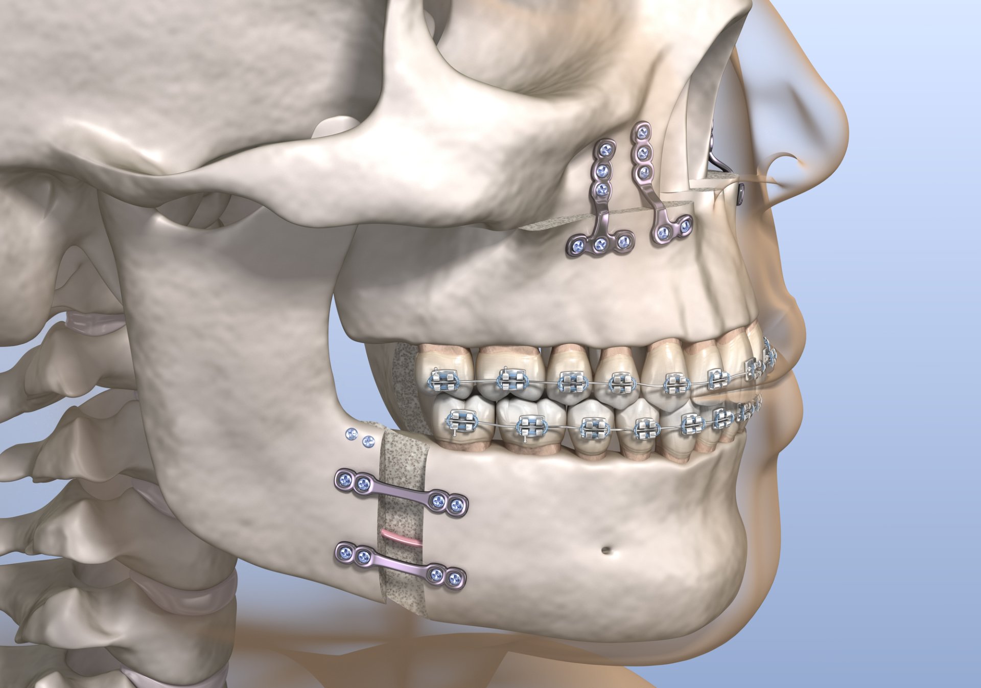 Cirurgia de mandíbula e maxilar - Consulta Ideal