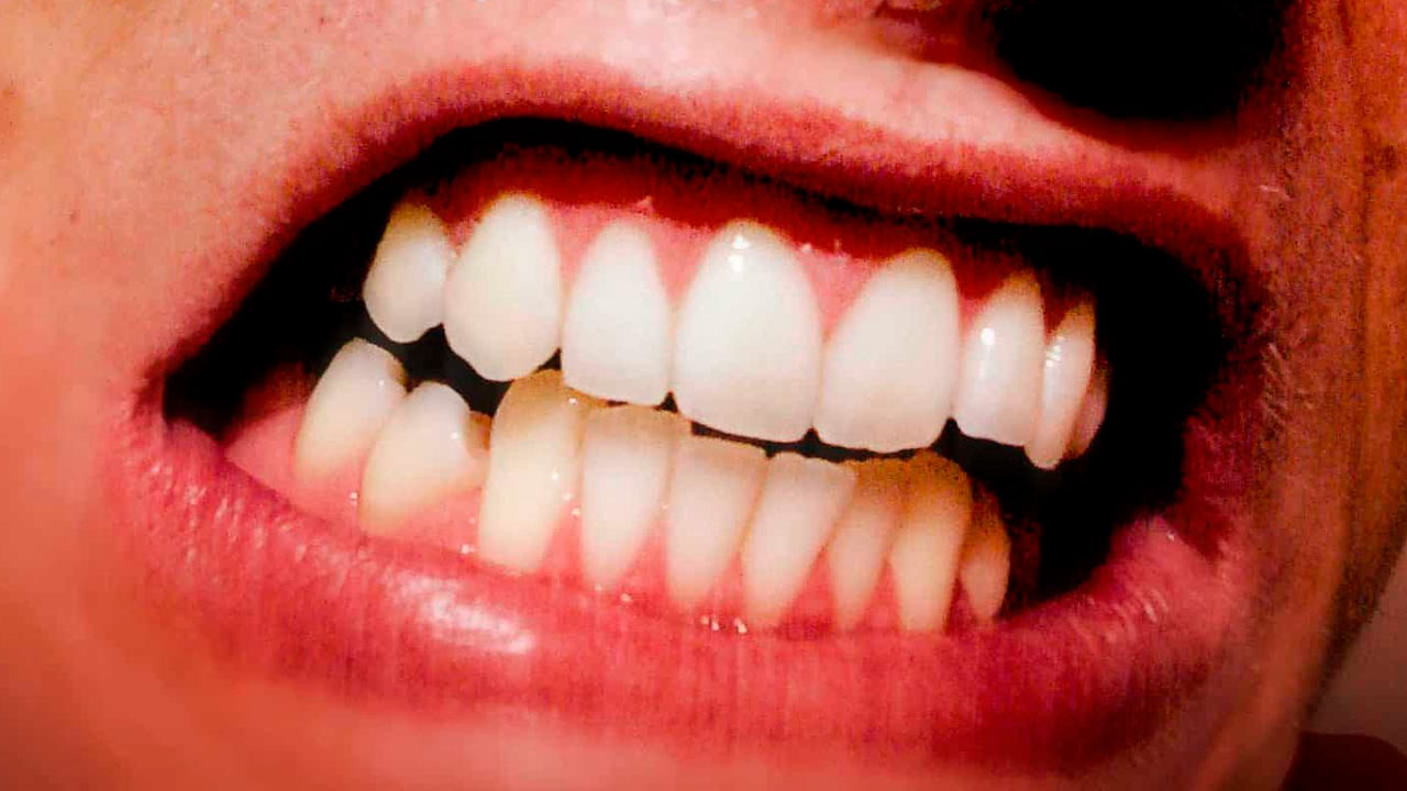 Bruxismo do sono - saiba como evitar as dores e desgastes dos dentes